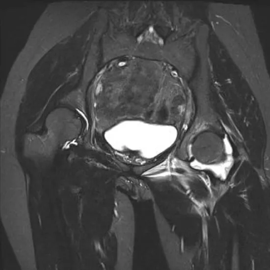 MRI Left Hip With Contrast